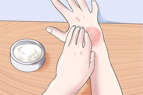 凍瘡年年復發(fā)什么辦 凍瘡復發(fā)的原因