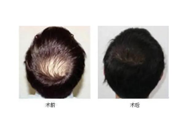 植發(fā)會(huì)自己生長嗎 植發(fā)會(huì)失敗嗎