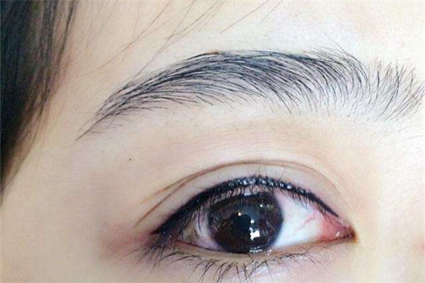 美瞳線(xiàn)紋了眼睛要腫幾天 美瞳線(xiàn)腫了可以用冰袋消腫嗎