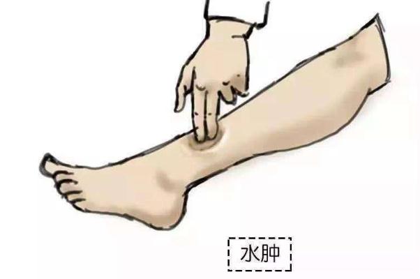 水腫是什么意思 過(guò)敏性水腫癥狀有哪些