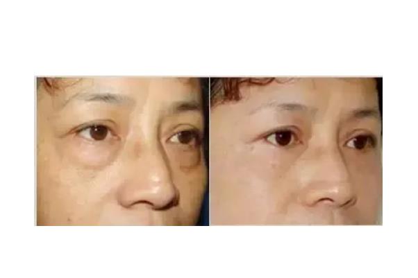 去眼袋手術(shù)會(huì)把臥蠶去掉嗎 去眼袋手術(shù)對(duì)眼有傷害嗎