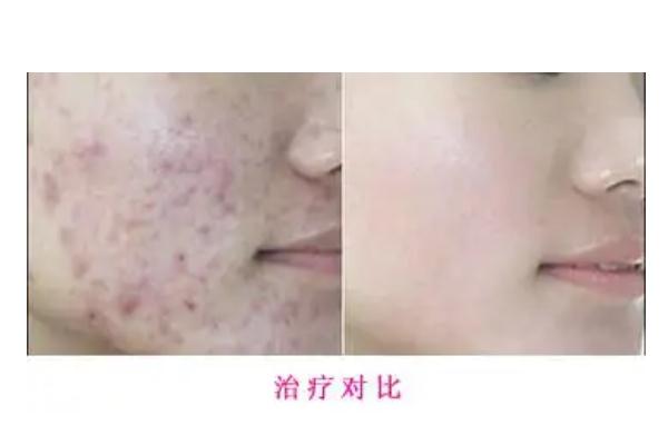 紅藍(lán)光祛痘印多久見(jiàn)效 紅藍(lán)光祛痘要做多少次