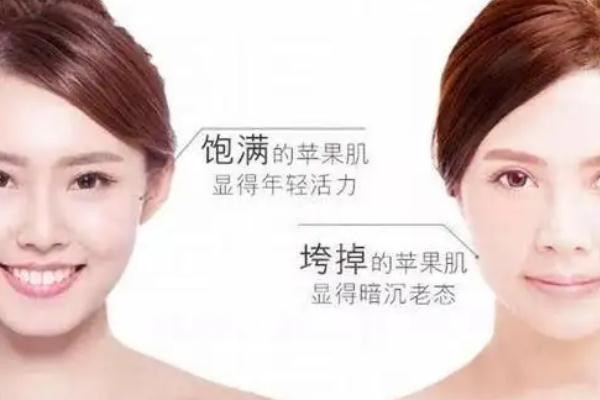 蘋(píng)果肌復(fù)位術(shù)怎么做 蘋(píng)果肌復(fù)位術(shù)可以保持多久